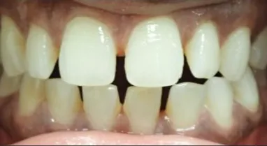 Gapped Teeth and Open Bite treated with clear aligners before orthodontic treatment at Elate Orthodontics, case 3788