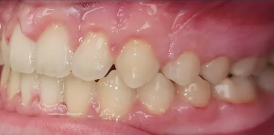 Gapped Teeth and Open Bite treated with braces after orthodontic treatment at Elate Orthodontics, case 3956