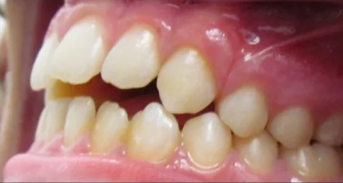 Gapped Teeth and Open Bite treated with braces before orthodontic treatment at Elate Orthodontics, case 3956