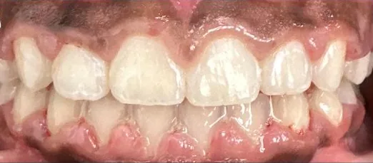 Gapped Teeth and Open Bite treated with braces after orthodontic treatment at Elate Orthodontics, case 3964