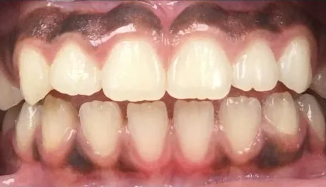Gapped Teeth and Open Bite treated with braces before orthodontic treatment at Elate Orthodontics, case 3964