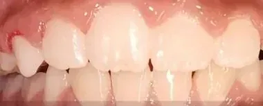 Gapped Teeth, Open Bite and Overjet treated with expander and braces after orthodontic treatment at Elate Orthodontics, case 3998