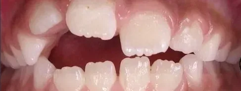 Gapped Teeth, Open Bite and Overjet treated with expander and braces before orthodontic treatment at Elate Orthodontics, case 3998