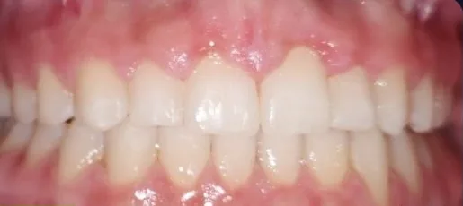 Gapped Teeth and Overbite treated with clear aligners after orthodontic treatment at Elate Orthodontics, case 3554