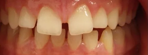 Gapped Teeth and Overbite treated with clear aligners before orthodontic treatment at Elate Orthodontics, case 3554