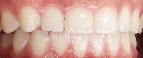 Gapped Teeth and Overbite treated with clear aligners after orthodontic treatment at Elate Orthodontics, case 3800