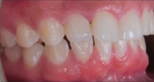 Gapped Teeth and Overbite treated with clear aligners before orthodontic treatment at Elate Orthodontics, case 3800