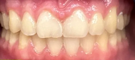 Gapped Teeth and Overbite treated with clear aligners after orthodontic treatment at Elate Orthodontics, case 3820