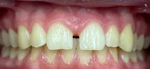 Gapped Teeth and Overbite treated with clear aligners before orthodontic treatment at Elate Orthodontics, case 3820