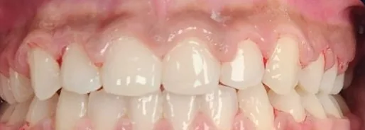 Gapped Teeth and Overbite treated with braces after orthodontic treatment at Elate Orthodontics, case 3856