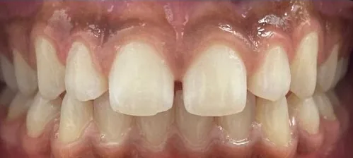 Gapped Teeth and Overbite treated with braces before orthodontic treatment at Elate Orthodontics, case 3856