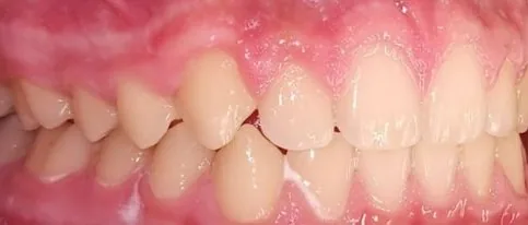 Gapped Teeth and Overbite treated with clear aligners after orthodontic treatment at Elate Orthodontics, case 3868