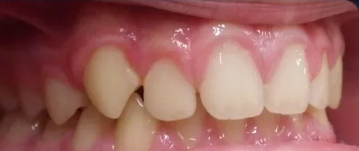 Gapped Teeth and Overbite treated with clear aligners before orthodontic treatment at Elate Orthodontics, case 3868