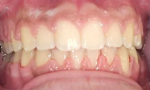Gapped Teeth, Overbite and Overjet treated with braces after orthodontic treatment at Elate Orthodontics, case 3884