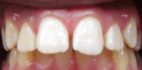 Gapped Teeth, Overbite and Overjet treated with braces before orthodontic treatment at Elate Orthodontics, case 3884