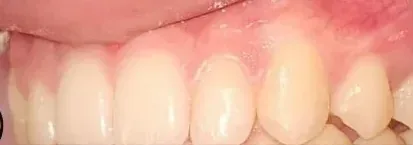 Gapped Teeth and Overbite treated with braces after orthodontic treatment at Elate Orthodontics, case 3920