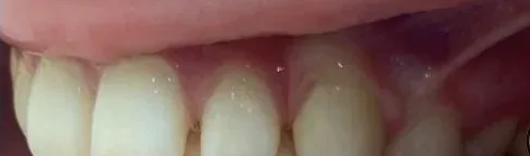 Gapped Teeth and Overbite treated with braces before orthodontic treatment at Elate Orthodontics, case 3920
