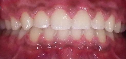 Gapped Teeth and Overbite treated with braces after orthodontic treatment at Elate Orthodontics, case 3960