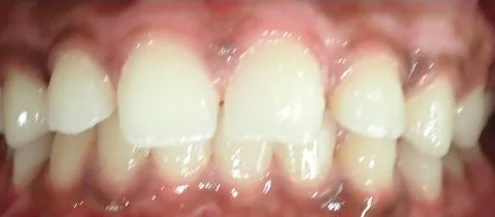 Gapped Teeth and Overbite treated with braces before orthodontic treatment at Elate Orthodontics, case 3960