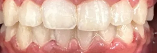 Gapped Teeth and Overbite treated with braces after orthodontic treatment at Elate Orthodontics, case 4018