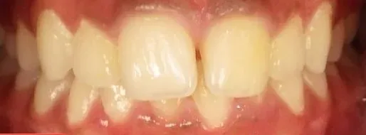 Gapped Teeth and Overbite treated with braces before orthodontic treatment at Elate Orthodontics, case 4018