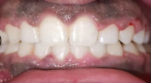 Gapped Teeth, Overbite and Overjet treated with braces after orthodontic treatment at Elate Orthodontics, case 4026