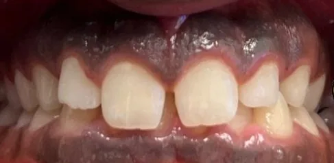 Gapped Teeth, Overbite and Overjet treated with braces before orthodontic treatment at Elate Orthodontics, case 4026