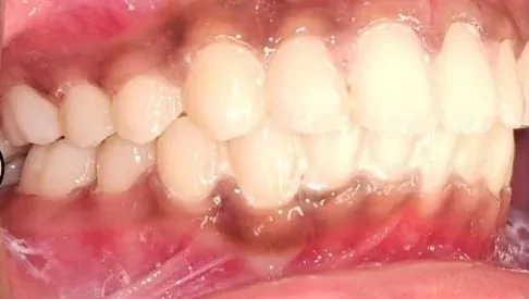 Gapped Teeth, Overbite and Overjet treated with braces after orthodontic treatment at Elate Orthodontics, case 4046
