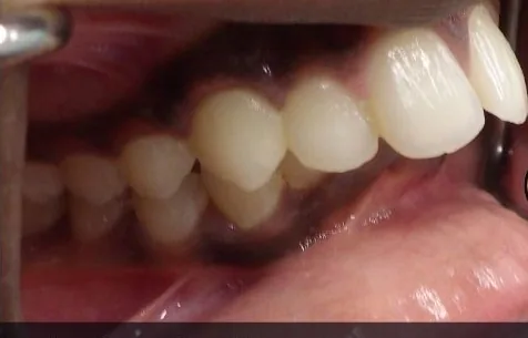 Gapped Teeth, Overbite and Overjet treated with braces before orthodontic treatment at Elate Orthodontics, case 4046