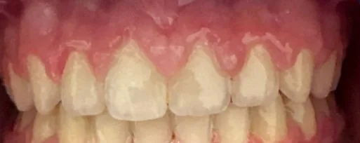 Gapped Teeth and Overbite treated with braces after orthodontic treatment at Elate Orthodontics, case 4070