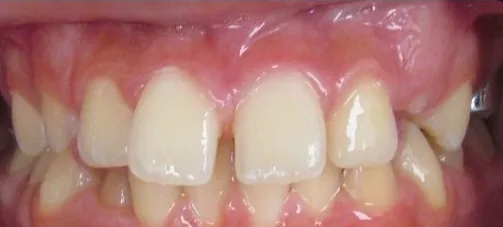 Gapped Teeth and Overbite treated with braces before orthodontic treatment at Elate Orthodontics, case 4070