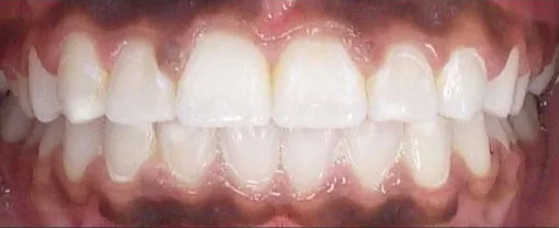 Gapped Teeth and Overjet treated with braces after orthodontic treatment at Elate Orthodontics, case 3776
