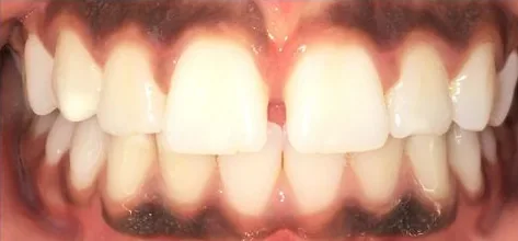Gapped Teeth and Overjet treated with braces before orthodontic treatment at Elate Orthodontics, case 3776