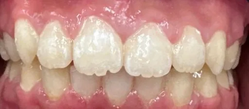 Gapped Teeth, Overjet and Impacted Teeth treated with braces after orthodontic treatment at Elate Orthodontics, case 3834