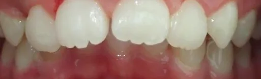 Gapped Teeth, Overjet and Impacted Teeth treated with braces before orthodontic treatment at Elate Orthodontics, case 3834