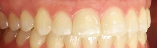 Gapped Teeth and Overjet treated with clear aligners after orthodontic treatment at Elate Orthodontics, case 3846