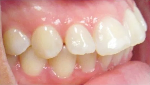 Gapped Teeth and Overjet treated with clear aligners before orthodontic treatment at Elate Orthodontics, case 3846