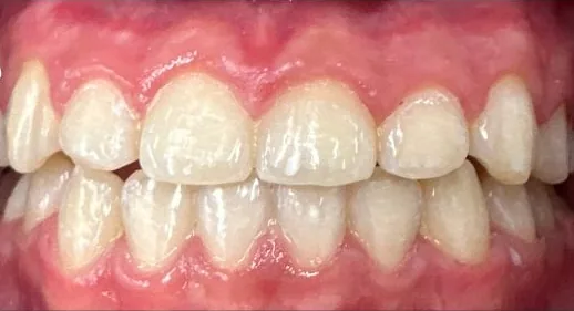 Underbite and Crowded Teeth treated with braces after orthodontic treatment at Elate Orthodontics, case 4014