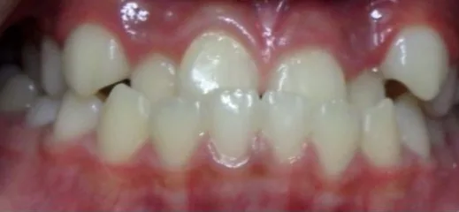 Underbite and Crowded Teeth treated with braces before orthodontic treatment at Elate Orthodontics, case 4014