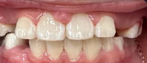 Underbite and Narrow Palate treated with braces and early treatment (phase i) after orthodontic treatment at Elate Orthodontics, case 3864