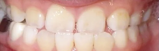 Underbite and Narrow Palate treated with braces and early treatment (phase i) before orthodontic treatment at Elate Orthodontics, case 3864