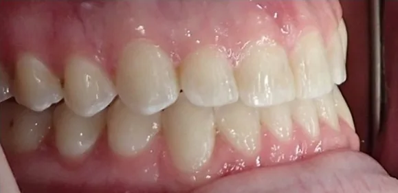 Underbite and Open Bite treated with jaw surgery and clear aligners after orthodontic treatment at Elate Orthodontics, case 3804