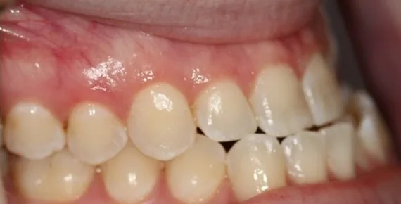 Underbite and Open Bite treated with jaw surgery and clear aligners before orthodontic treatment at Elate Orthodontics, case 3804