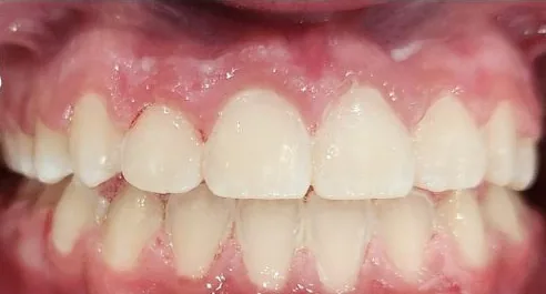 Underbite and Gapped Teeth treated with braces after orthodontic treatment at Elate Orthodontics, case 3872