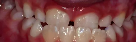 Underbite and Gapped Teeth treated with braces before orthodontic treatment at Elate Orthodontics, case 3872